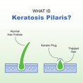 thumbnail image 4 of KP Elements Keratosis Pilaris Lotion (4 fl oz) - Natural Keratosis Pilaris Treatment Moisturizing & Exfoliating AHA Lotion for KP Vegan Made in USA, 4 of 5