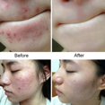 thumbnail image 3 of Promotion Clearance  Useful Mite Soap Rich In Sea Salt Quickly Remove Mites Repair Nourish Skin Personal Care Product, 3 of 6