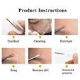 thumbnail image 5 of Pimple Popper Tool Kit, Blackhead Extractor tool for Face, Extractor Tool, 5 of 5