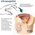 thumbnail image 4 of PENGXIANG Pince pour Points de Soins de la Prostate Pince pour Points d'Acuplus d'Acupression Pression Manuelle Soulage l'Inconfort de la Prostate Soulagement Sans Effort de la Migraine Soins des Reins, 4 of 7