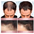 thumbnail image 5 of Zephta H-regrow 2.0, Zephta Hair Regrowth, Prorevita Rice Nutri Spray, For Hair, 5 of 5