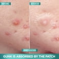 thumbnail image 4 of Garnier Pimple Patch , Invisible Hydrocolloid Patches, 22 Count, 4 of 8