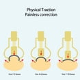 thumbnail image 4 of Professional Ingrown Toenail Lifter Stainless Steel Foot Clamp for Paronychia, 4 of 7