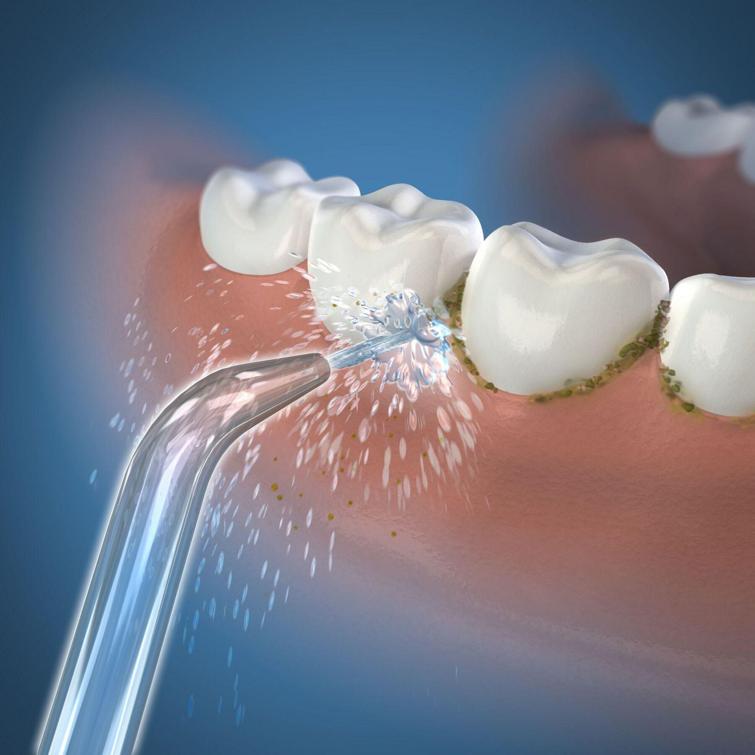 Waterpik® Embout Jet Classique
