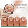 thumbnail image 2 of New Slinx Kerassentials Toenail Fungus Treatment Oil, Kerassentials For Toenail Fungus, 2 of 5