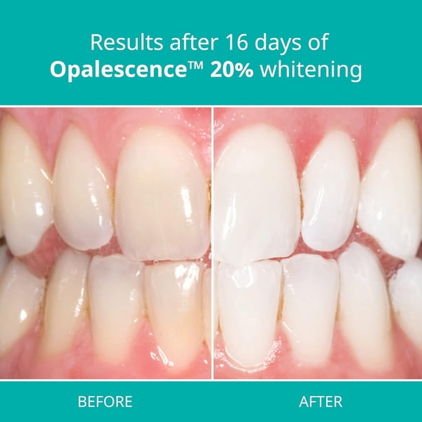 Opalescence 20% Teeth Whitening Refill Kit (2 Packs / 4 Syringes