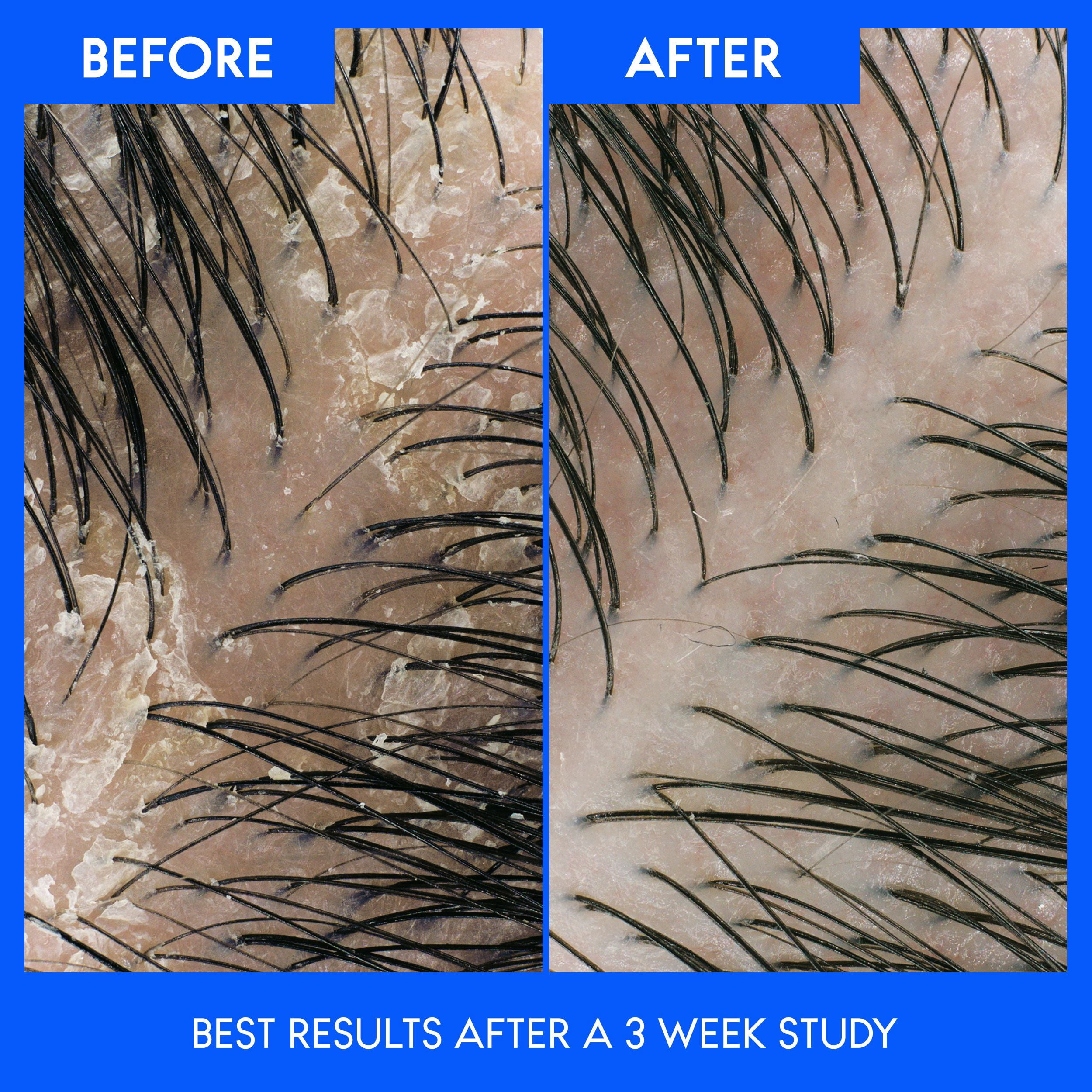 Head & Shoulders Deep Moisture 2-in-1 Anti-Dandruff Shampoo + Conditioner, 613ML