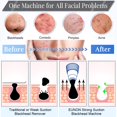 thumbnail image 3 of Blackhead Remover Pore Vacuum Blackhead Extractor Tool Facial Pore Vaccumm Whitehead Cleaner, 3 of 4