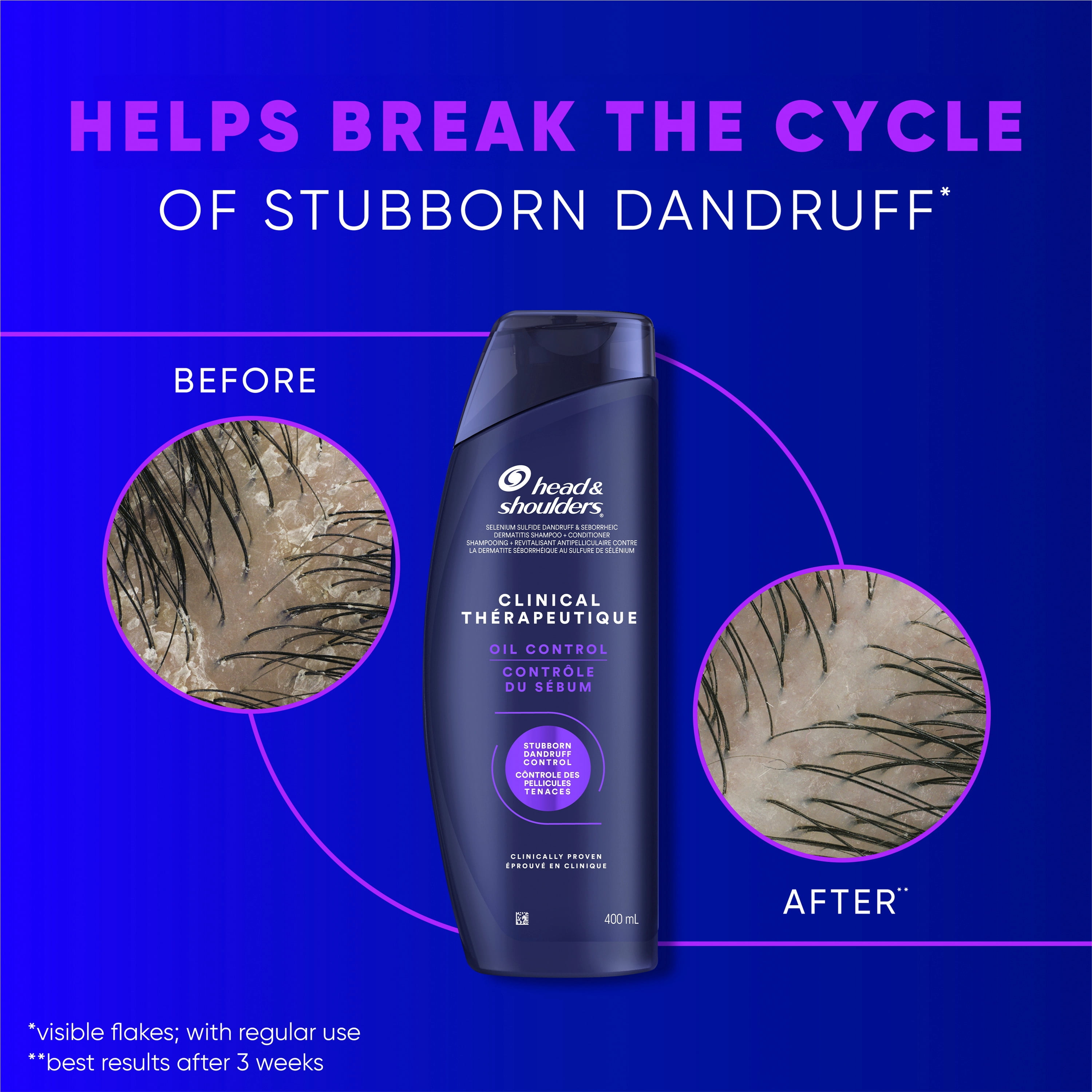 Head & Shoulders Dandruff Shampoo, Clinical Strength Oil Control, 1% Selenium Sulfide, Oily Scalp, Flake Protection, Stubborn Dandruff Control, Jasmine Scent, 400 mL
