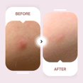 thumbnail image 2 of Maskeraide Spotted Daytime Invisible Patches, Acne Pimple Patches, Hydrocolloid Patches, 2 of 5