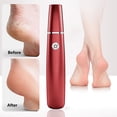 thumbnail image 1 of Birdeem Foot Callus Remover, Foot Callus Remover, Charging Electric Foot File with Multiple Speeds - Portable Callus Remover for Home Use, Foot File Callus Remover, Foot File Callus Remover, 1 of 5