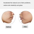 thumbnail image 1 of Skin Eraser Powerful Pen Red Blud Machine Therapy Pimple  Skin Care Repairing Instrument For  Scar Removal Improve Skin Elasticity, 1 of 8