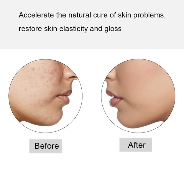 Skin Eraser Powerful Pen Red Blud Machine Therapy Pimple Skin Care Repairing Instrument For Scar Removal Improve Skin Elasticity