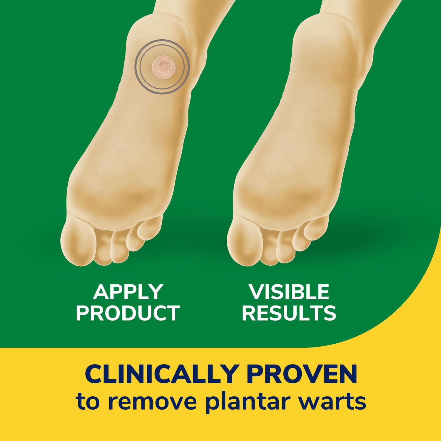 Dr. Scholl’s® Clear Away® Plantar Wart Remover, 24 Count Medicated Treatments