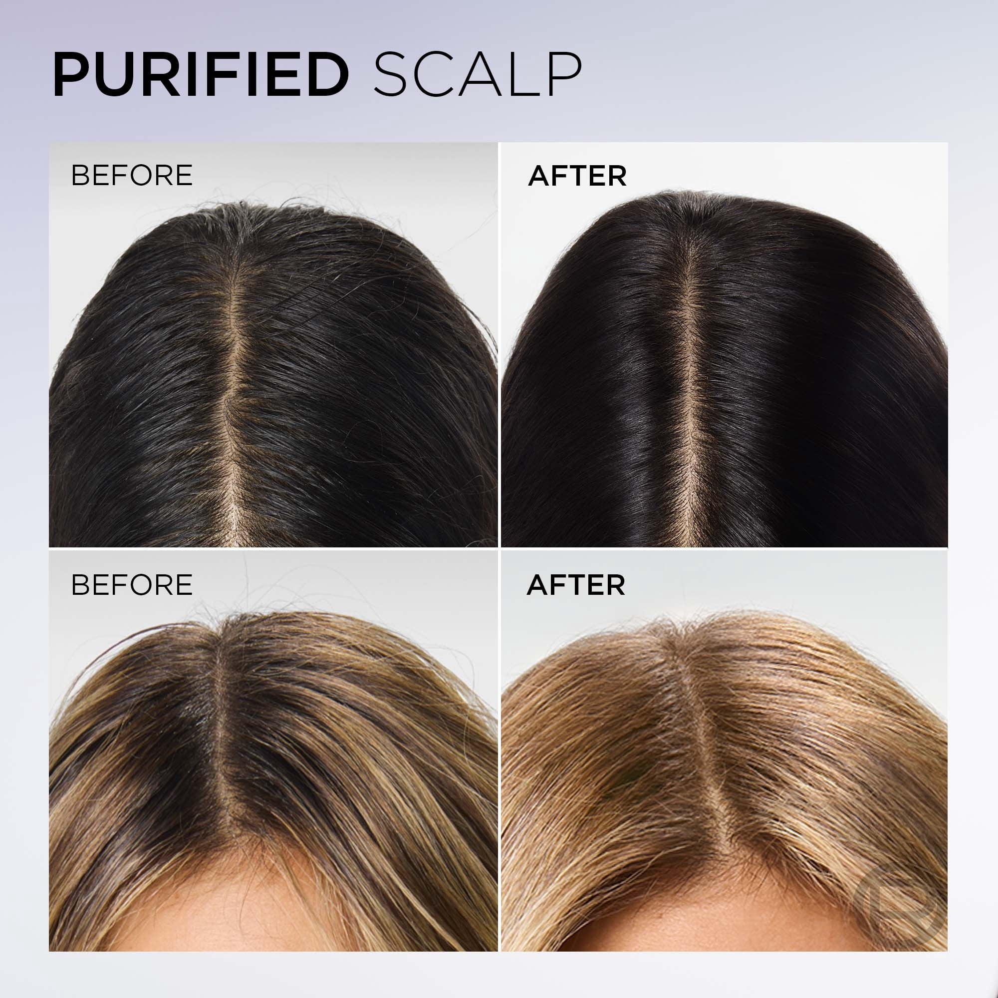 L'Oréal Paris, Hair Expertise, Hyaluron Pure Oil Erasing Scalp Serum, with Salicylic Acid, for Oily Roots and Dehydrated Lengths
