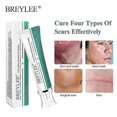 thumbnail image 2 of Breylee Crème pour Enlever les Cicatrices d'Acné: 30 g, Réparation de la Peau (1 Pcs), 2 of 5