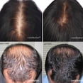 thumbnail image 4 of HairMax Ultima 12 LaserComb Home Hair Growth Device. 12 Medical Grade Lasers. Stimulate Hair Growth, Reverse Thinning, Regrow Denser, Fuller Hair. Targeted Hair Loss Treatment., 4 of 8