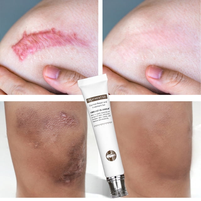Élimination des Cicatrices Marques de Cicatrice pour le Visage Ou le Corps