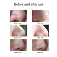thumbnail image 2 of Electric Blackhead Suction Device with 5 in 1 Pimple Zit, 2 of 8