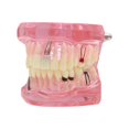 thumbnail image 1 of Dentalmall Teeth Model Teeth Typodonts Dental Implant Study Analysis Demonstration Teeth Model #2001 with Restoration Pink, 1 of 4