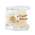 thumbnail image 4 of Modèle de Dent, Modèle Orthodontique, Modèle de Malocclusion Traitement Malocclusion pour l'Éducation Étudier Enseigner, 4 of 8