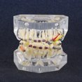 thumbnail image 1 of Modèle de Dent, Modèle Orthodontique, Modèle de Malocclusion Traitement Malocclusion pour l'Éducation Étudier Enseigner, 1 of 8