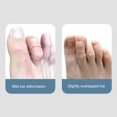 thumbnail image 4 of Dual Purpose Toe and Finger Corrector Splint, Aluminum Plate, Sponge Cloth Material, Toe , Suitable for Hammer Toes, Joint Realign, 4 of 7