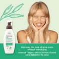 thumbnail image 2 of Aveeno Clear Complexion Foaming Cleanser, Acne Prone Skin, Scar, Acne Treatment, Hypoallergenic, 2 of 5