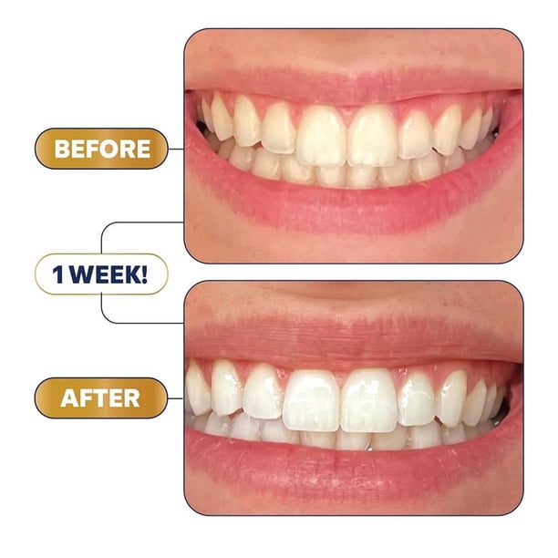 Lumineux Teeth Whitening Strips - 42 Strips 21 Treatments Kit
