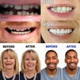 thumbnail image 2 of Artificial Teeth Dentures Temporary Quick Dental Prosthesis Top Perfect Smile Veneers, Repair Your Tooth Quickly, Make You Smile Confidently, 2 of 5