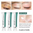 thumbnail image 3 of Breylee Crème pour Enlever les Cicatrices d'Acné: 30 g, Réparation de la Peau (1 Pcs), 3 of 5