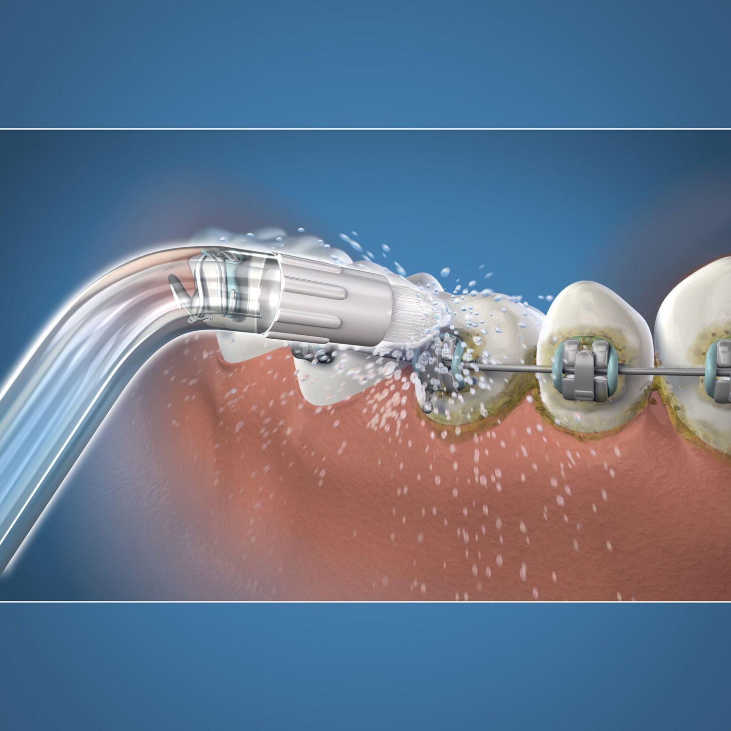 Embout Orthodontique Waterpik®