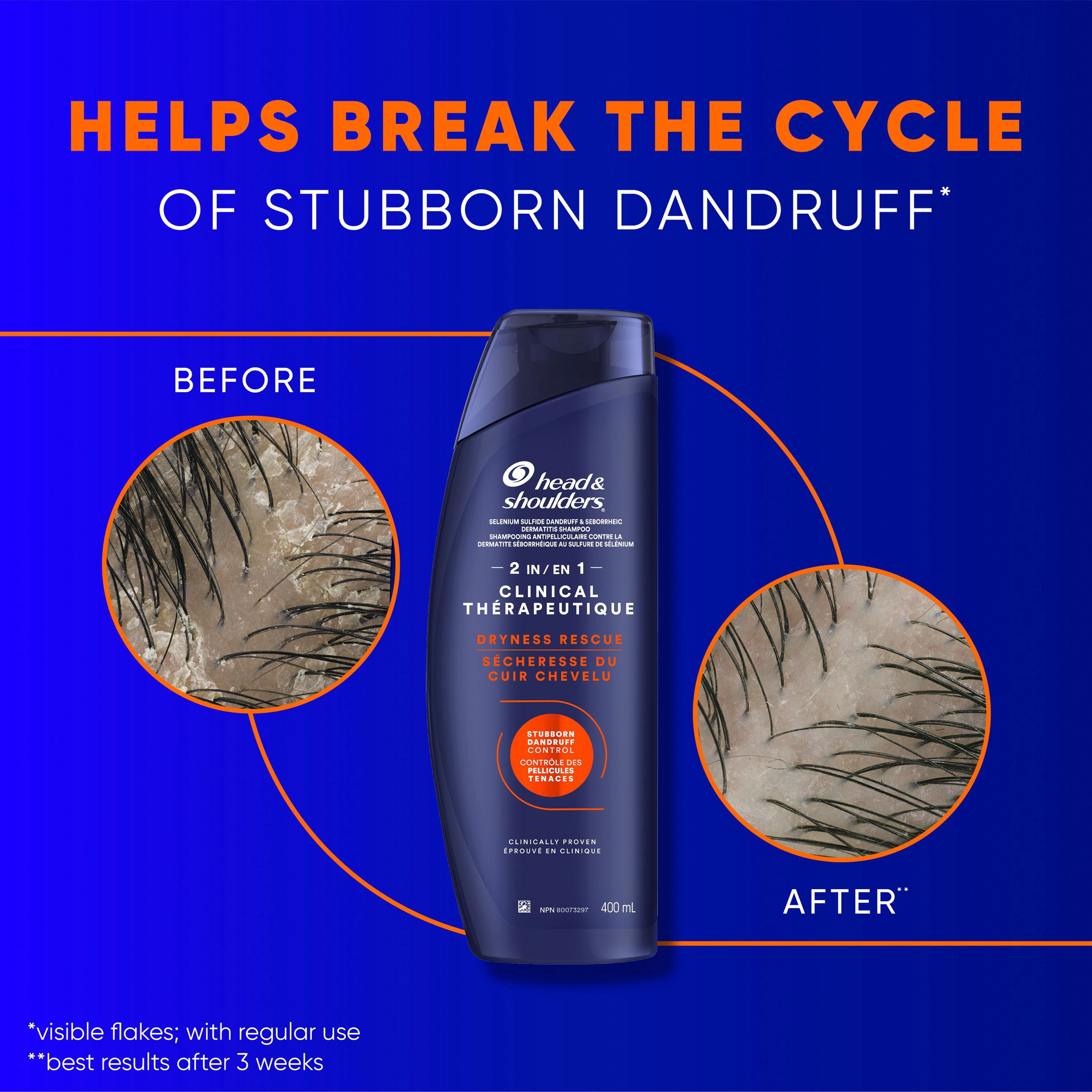 Head & Shoulders Clinical Dryness Rescue 2in1, for Stubborn Dandruff