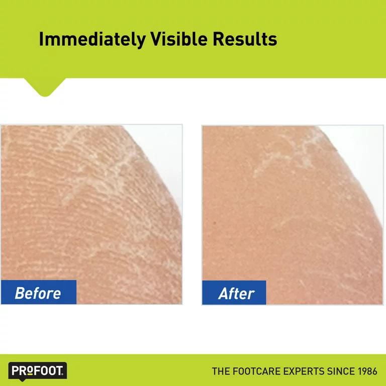 Profoot cracked sale heel cream