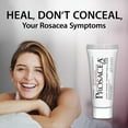thumbnail image 4 of Prosacea Rosacea Treatment Gel, 4 of 7