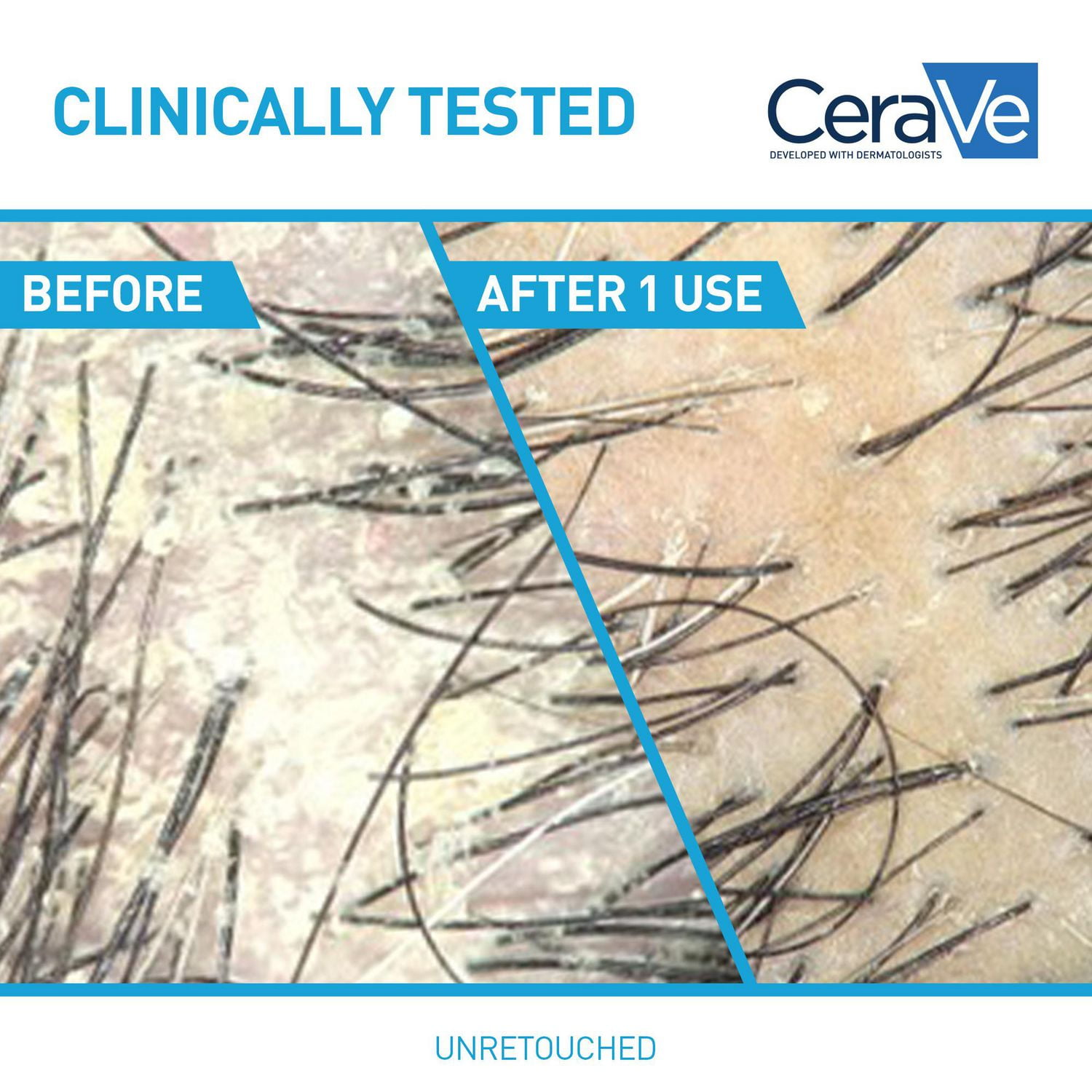CeraVe 2-en-1 shampooing et revitalisant hydratant antipelliculaire pour hommes et femmes, nettoie en douceur le cuir chevelu et les cheveux tout en réduisant les pellicules, les démangeaisons et l'irritation, 355mL Réduit les pellicules