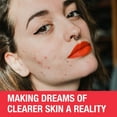 thumbnail image 3 of Neutrogena Traitement AM Acné tenace - Poussée d'acné, Peroxyde de benzoyle, Sans parfum, 3 of 9