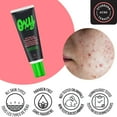 thumbnail image 4 of Oxy Deep Pore Acne Vanishing Treatment - 5% Benzoyl Peroxide – Stubborn Acne Control - Helps Treat, and Prevent Breakouts – Allows Skin to Heal - Dermatologist Tested, 4 of 7